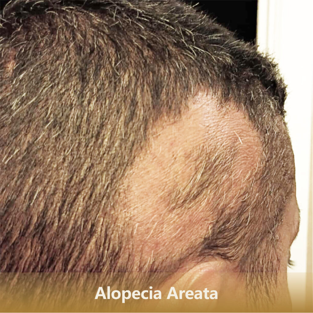 Home 2 斑秃Alopecia Areata 1 1024x1024